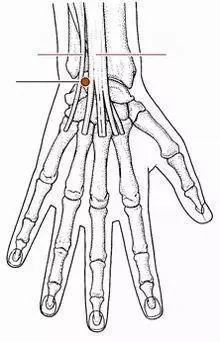 Fire Needle Therapy for Rheumatoid Arthritis