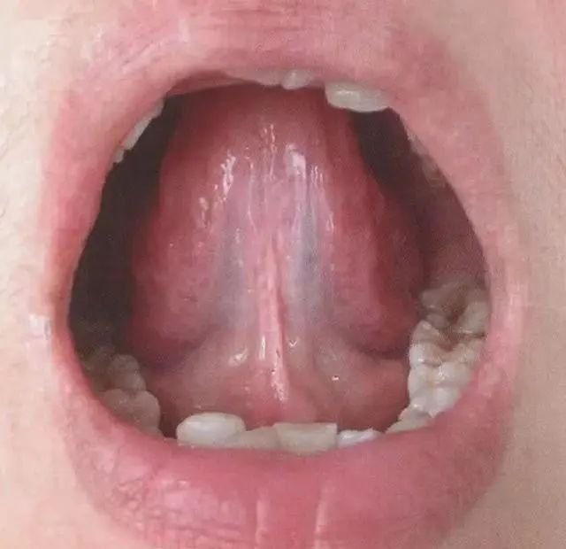 Understanding the Sublingual Collaterals in Traditional Chinese Medicine