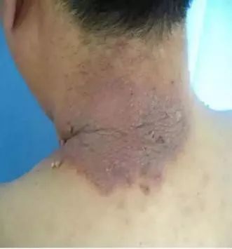 Fire Needle Therapy for Treating Neurodermatitis