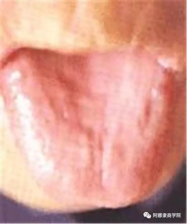 A Comprehensive Guide to 22 High-Definition Tongue Diagnosis Images: Understand Diseases Through Tongue Observation!