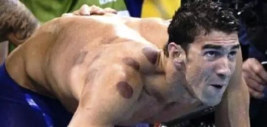 Cupping Therapy: Do You Really Understand It?