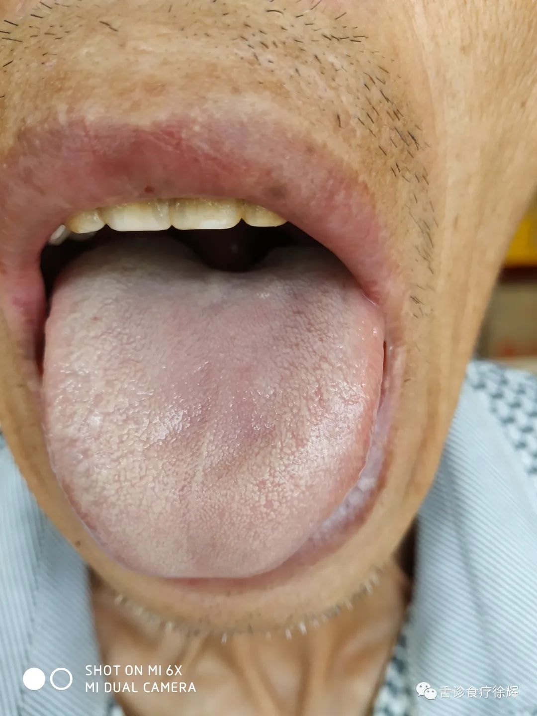 Distinguishing Between Yang Deficiency and Blood Deficiency with Pale Tongue