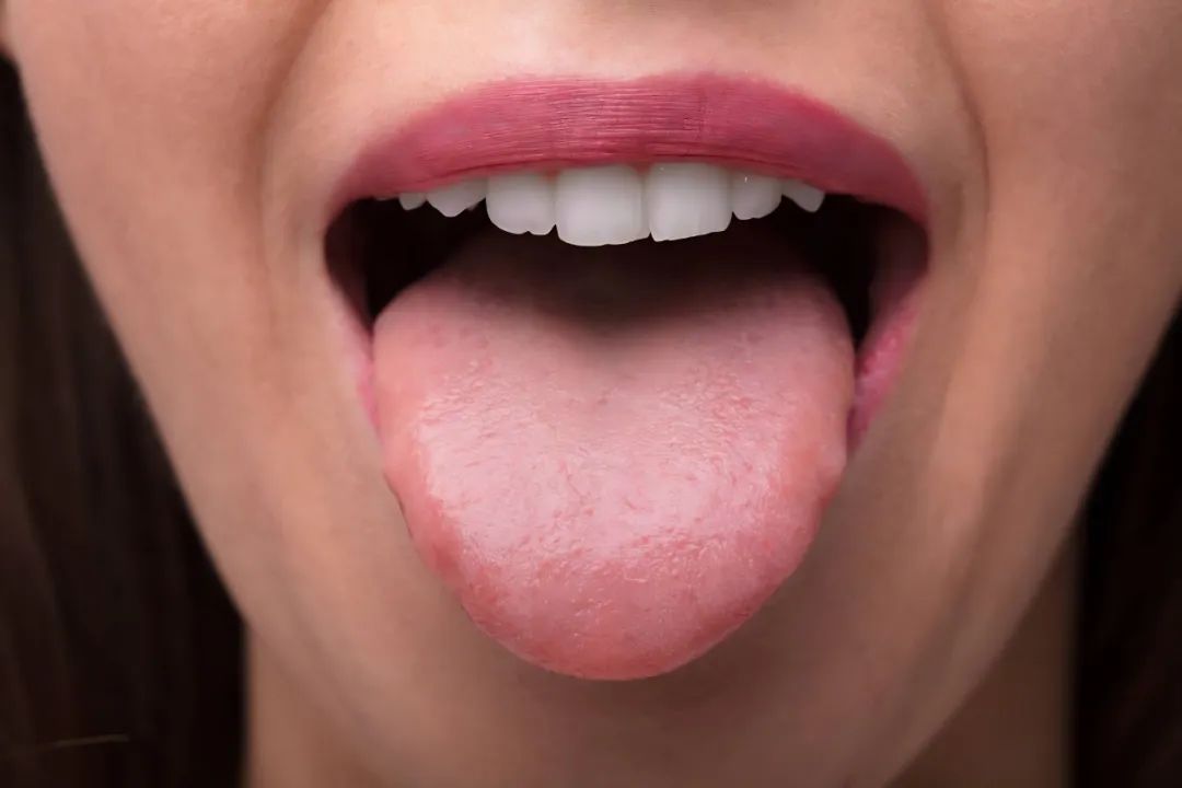 10 Types of Tongue Appearance That May Indicate Illness