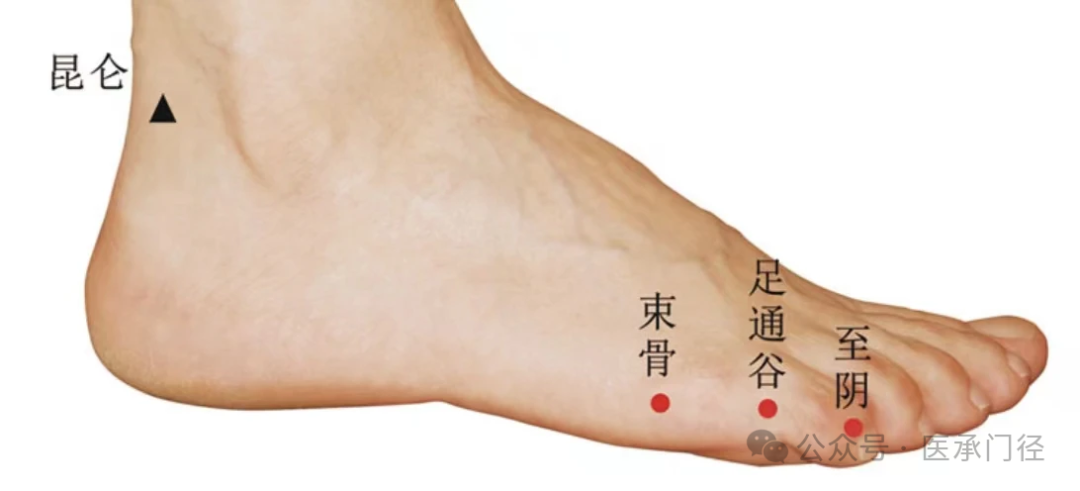 Traditional Fine Needle Technique for Acupuncture Treatment of Sciatica