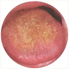 Observing Tongue Coating to Assess Health: A Summary of Classic Tongue Signs in Traditional Chinese Medicine