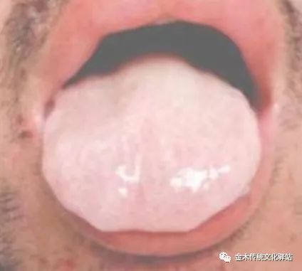Tongue Diagnosis in Traditional Chinese Medicine: Characteristics of Tongue Coating