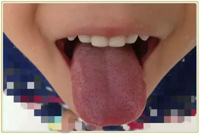 Tongue Diagnosis: Warning Signs of Spleen Yin Deficiency in Children with Thin Build and Pale Complexion