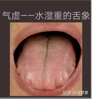 Qi Deficiency Constitution: Tongue Manifestations of Dampness and Methods for Regulation