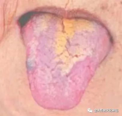 Tongue Diagnosis in Traditional Chinese Medicine: Tongue Coating