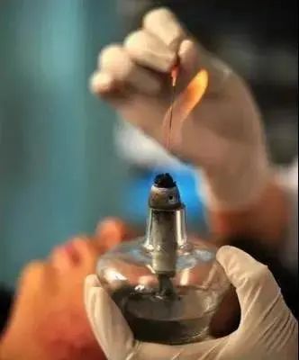 Traditional Chinese Medicine: Fire Needle Therapy