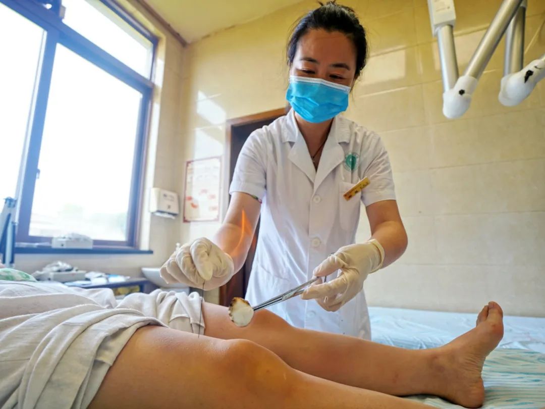 The Marvel of Fire Needle Therapy in Traditional Chinese Medicine