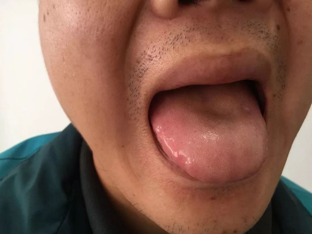 A Series on Tongue Diagnosis