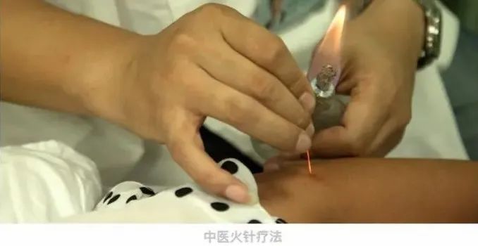 Acupuncture Specialty Treatment - Fire Needle