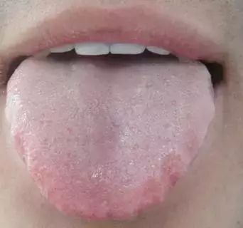 Comprehensive Guide to Tongue Diagnosis: Learn How Your Tongue Reflects Your Health!