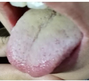 Analysis of Clinical Patterns and Treatments for Summer Damp-Heat Syndrome (6): Typical Damp-Heat Case Studies