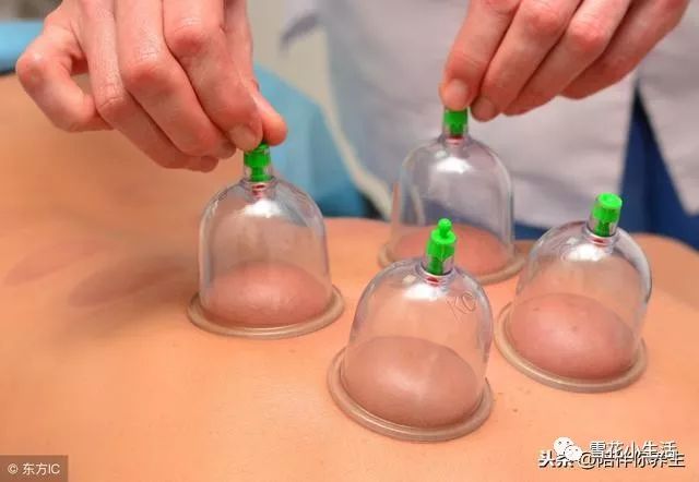 Is Cupping Good? TCM and Western Medicine Warn: This Way of Cupping Could Shorten Your Life, Please Be Aware!