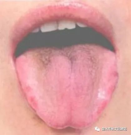 Tongue Diagnosis in Traditional Chinese Medicine: Tongue Coating