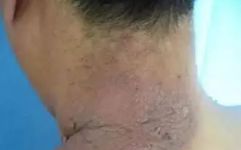 Fire Needle Therapy for Treating Neurodermatitis