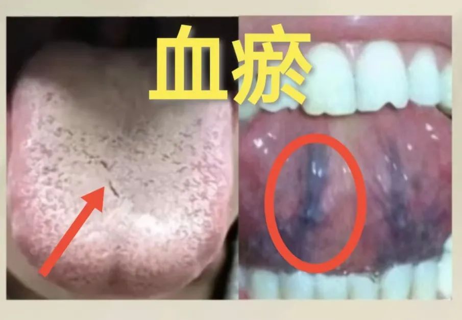 Three Strategies to Alleviate Stagnation, Blood Deficiency, and Yang Deficiency in TCM