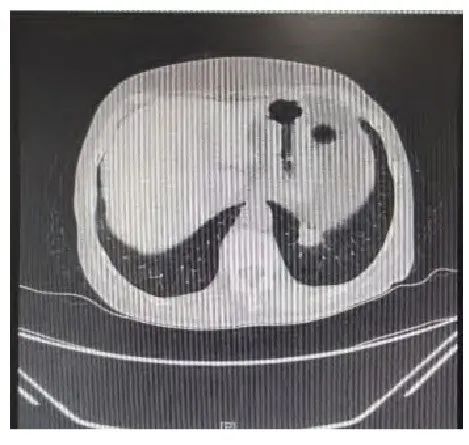 Professor Yan Guizhen's Experience in Treating Pulmonary Nodules Using the Principle of Supporting the Right and Expelling Pathogenic Factors