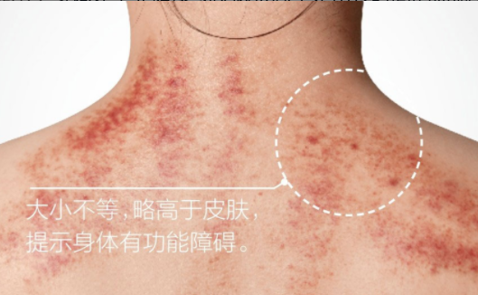 Understanding the Signs of Gua Sha: Master These 5 Colors and 4 Shapes for Better Health