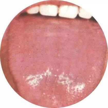 Observing Tongue Coating to Predict Diseases