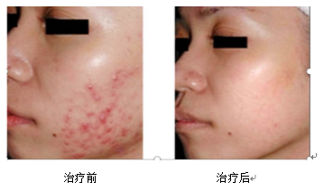 Fire Needle Therapy for Skin Diseases: Visible Safety and Efficacy