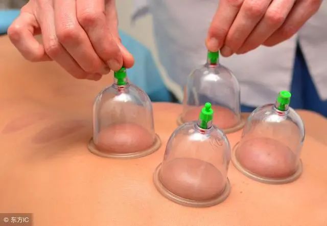 The Art of Cupping in Traditional Chinese Medicine: 5 Contraindications and Analysis of Cupping Marks