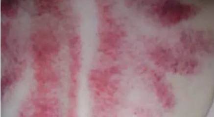 Caution After Gua Sha: Risks of Blood Vessel Rupture and Precautions for Certain Individuals