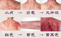 Gua Sha: A Traditional Chinese Medicine Therapy
