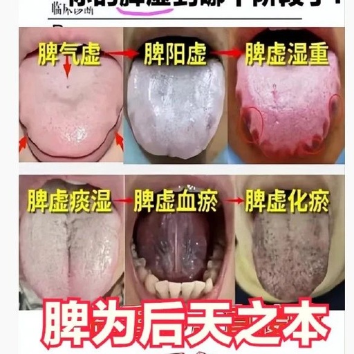 Five Stages from Spleen Qi Deficiency to Blood Stasis: What Are the Changes in Tongue Appearance?