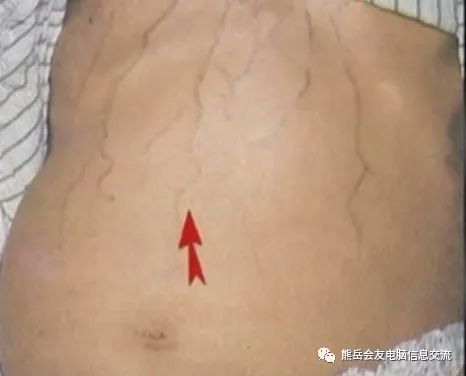 Expert Advice: Identifying Blood Stasis Diseases Through Visible Veins