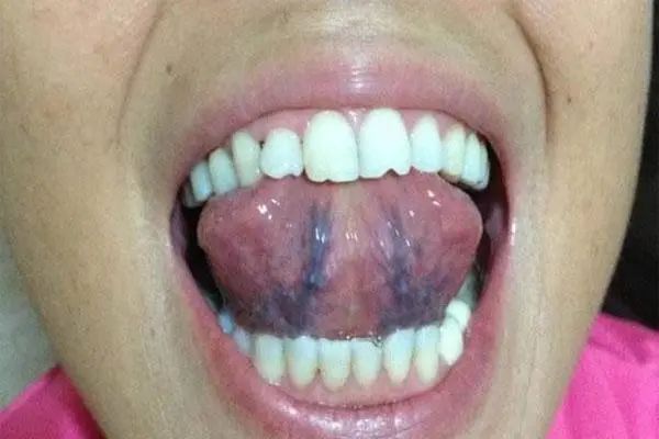 Stasis of Blood as the Root of All Illness: Six Signs Indicating Blood Stasis in Your Body