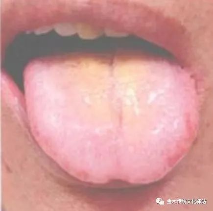 Tongue Diagnosis in Traditional Chinese Medicine: Tongue Coating