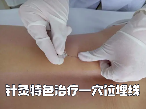 Acupuncture Specialty Treatment - Fire Needle