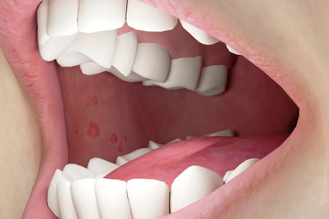 10 Types of Tongue Appearance That May Indicate Illness