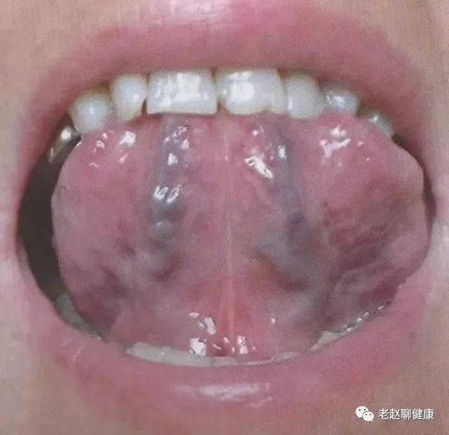 Tongue Diagnosis │ Sublingual Collaterals
