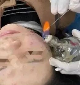The Powerful Energy of Fire Needles