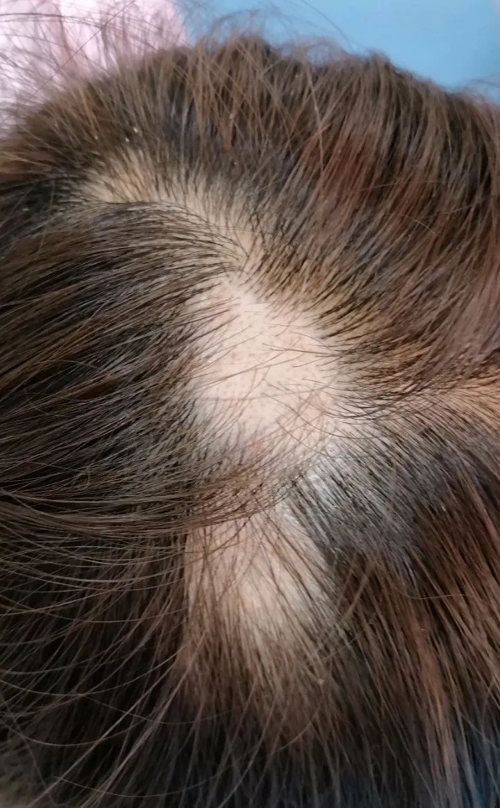 Fire Needle Therapy for Alopecia Areata in Traditional Chinese Medicine
