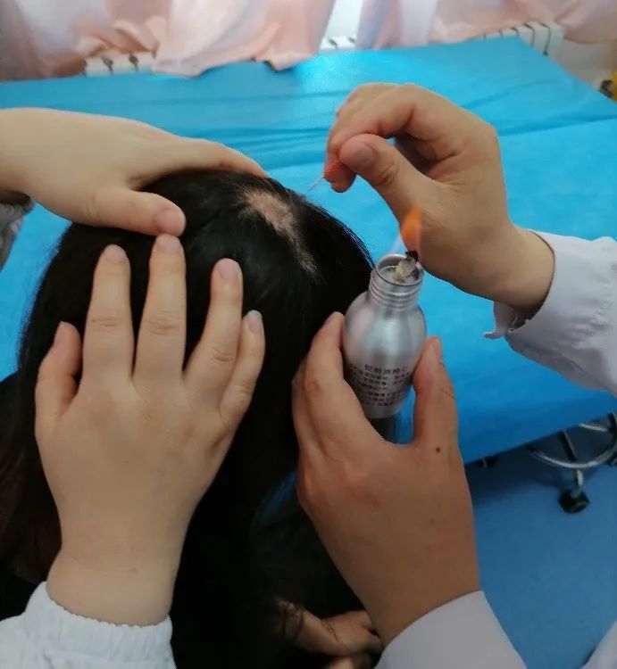 Fire Needle Therapy for Alopecia Areata in Traditional Chinese Medicine