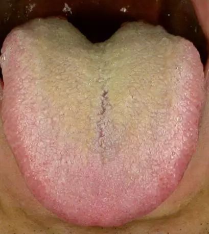 Understanding Phlegm-Dampness: How to Address Cold Phlegm and Phlegm-Heat