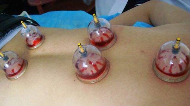 The Therapeutic Benefits of Bloodletting in Traditional Chinese Medicine