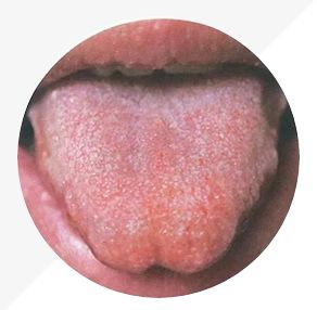 Understanding Tongue Diagnosis in TCM: Insights into Health from Tongue Appearance (Part 2)