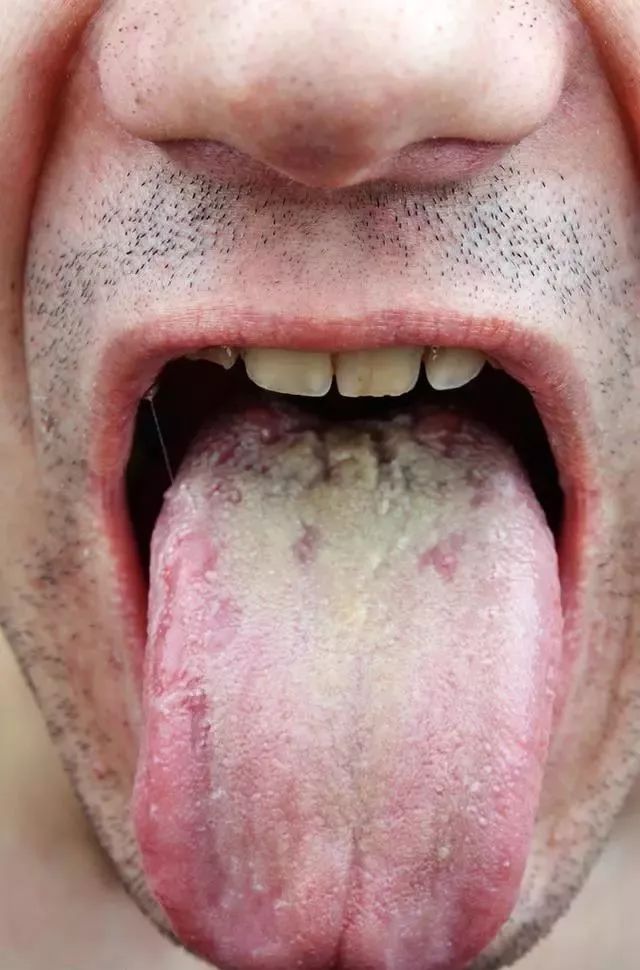 Tongue Diagnosis in Traditional Chinese Medicine: Observing Tongue Color, Shape, State, and Coating