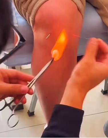 Fire Needle Therapy: Ancient Method with New Charm, Where Does Pain Go?