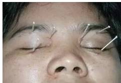 The Miraculous "Three Needles" in TCM Acupuncture: Treating One Disease with Three Acupuncture Points