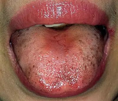 Blood Stasis and Its Impact on Health: How to Care for Individuals with Blood Stasis Constitution