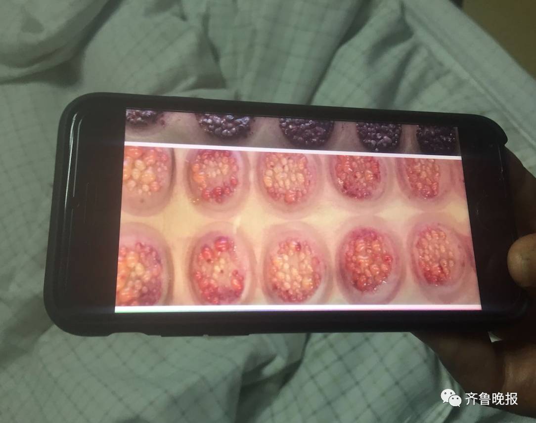 Woman Suffers Severe Burns and Coma After Intensive Cupping Therapy: The Risks of Cupping Explained