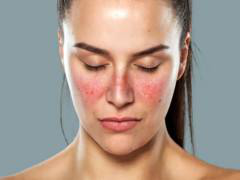 The Pattern of 'Yin Excess and Yang Deficiency' in Systemic Lupus Erythematosus