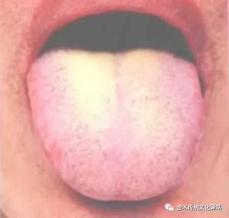 Tongue Diagnosis in Traditional Chinese Medicine: Tongue Coating